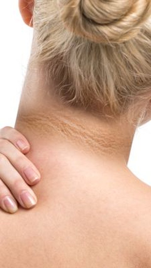 Apa Penyebab Leher Hitam? Bisakah Diatasi Hanya dengan Menggunakan Skincare?<br>