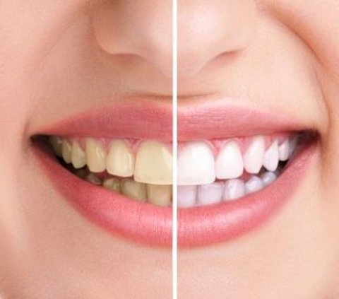 Bisakah Pasta Gigi Mencegah Kerusakan Gigi? Tips Memilih Produk yang Sesuai