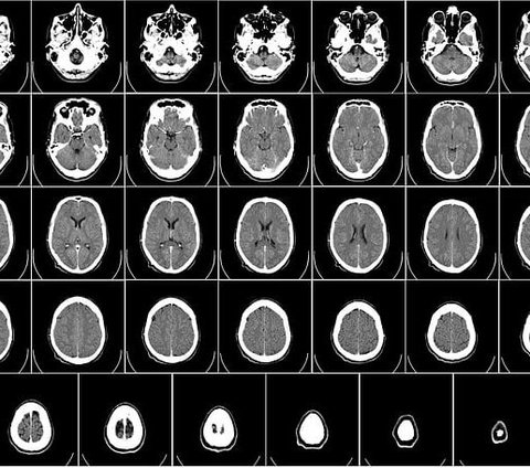 Dari hal itu muncul, seberapa layakkah melakukan transplantasi otak? Apa saja kepraktisan dalam operasi paling menantang yang pernah dilakukan? <br>