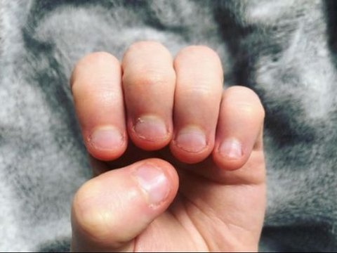 The Risk of Biting Nails