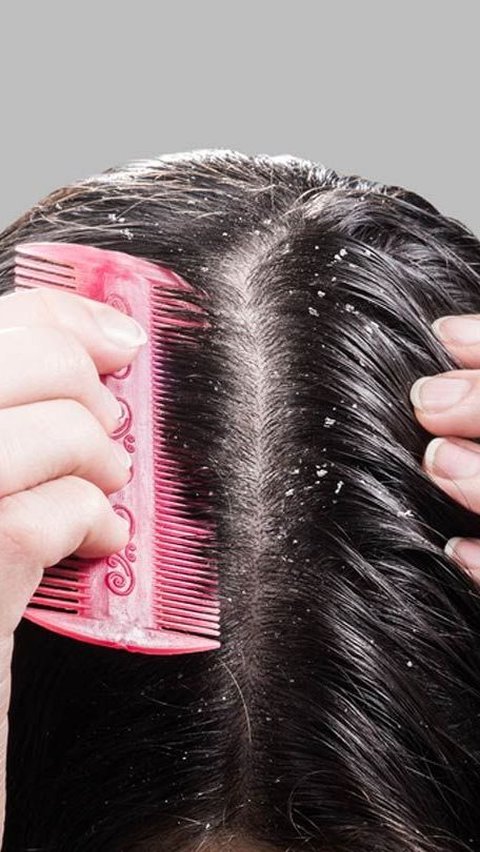 Signs of Infrequent Shampooing