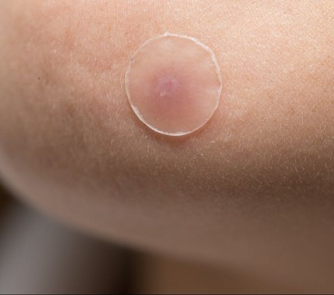 Is Acne Patch Effective in Treating Acne? Let's Find Out