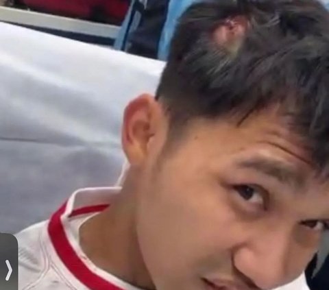 8 Photos of Witan Sulaeman with Bandage on His Head during Indonesia Vs Guinea Went Viral, Netizens: Looks Like Wearing a Peci