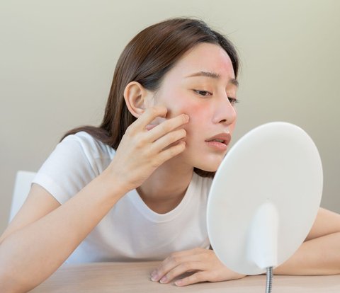Using Acne Patch for Too Long Can Cause Irritation, Check Out the Doctor's Explanation