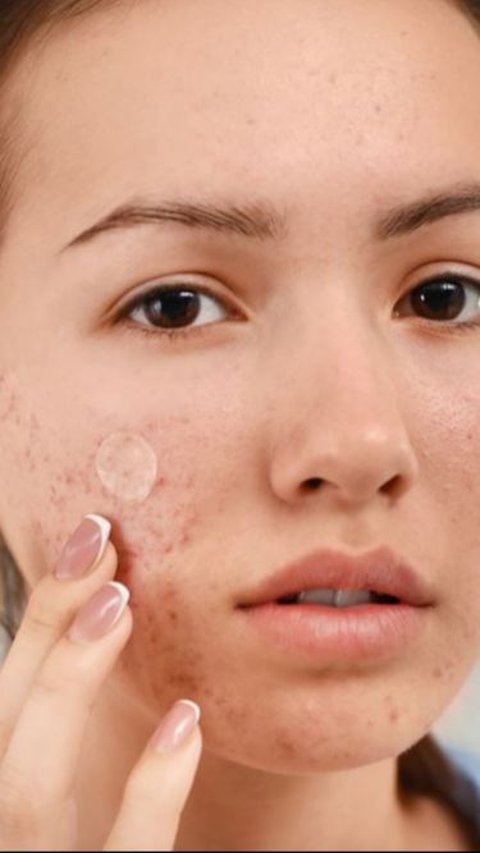 Terdapat tiga jenis acne patch yang perlu diketahui untuk memilih sesuai kebutuhan: