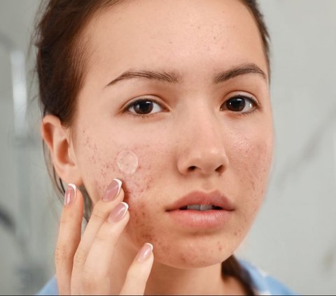Step Skincare Penting Saat Kulit Sedang Berjerawat