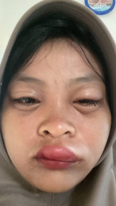 Because Riding a Motorcycle Without Wearing a Mask, This Girl's Lips Ended Up Swollen by a Bee Sting