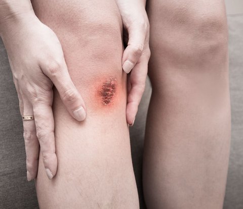 Don't Use Band-Aids Immediately, Here's the Right Way to Treat Wounds