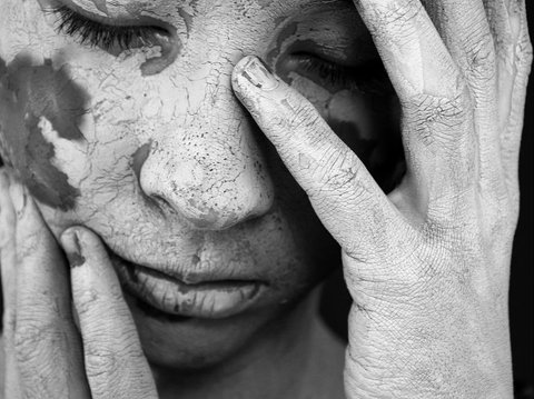 Cara Menyembuhkan Vitiligo