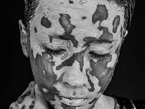 Pengertian dan Gejala Vitiligo