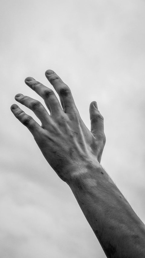 Cara Menyembuhkan Vitiligo dengan Cepat, Ketahui Penyebabnya