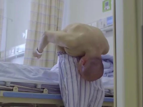 Touching Story of the Folded Human, His Body Stands Tall Again After Being Bent for 28 Years