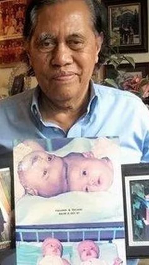 Bayi Kembar Siam Pertama Indonesia, Kini Nasibnya Cemerlang Sukses Jadi Dokter Dulu Ditolong Sosok ‘Malaikat tak Bersayap'