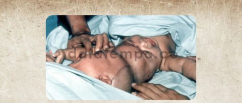 Sosok Padmosantjojo Dokter yang Berhasil Lakukan Operasi Bayi Kembar Siam Pertama di Indonesia, Tak Tarik Biaya Sepeser pun dari Pasien