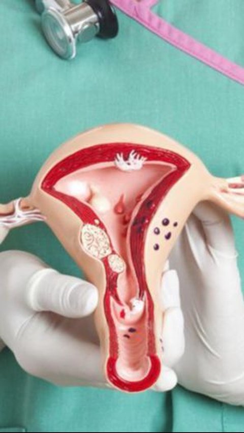Faktor Risiko Kanker Ovarium yang Perlu Diwaspadai, Ketahui Cara Mencegahnya<br>