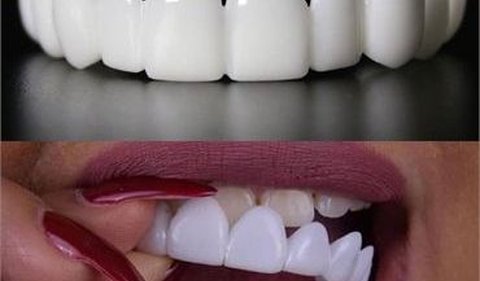 <b>Temporary Veneer</b>