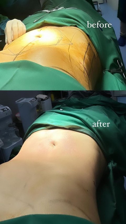 Hanum undergoes liposuction surgery to remove fat from her stomach and waist.