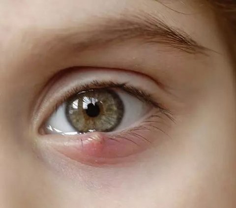 9 Physical Signs When Cholesterol is High, One of Them is a Lump in the Eye