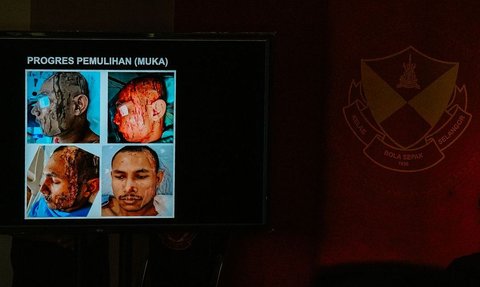 Pemain Timnas Malaysia Disiram Air Keras, Begini Penampakannya Kini Bikin Miris Tak Bisa Peluk Anak