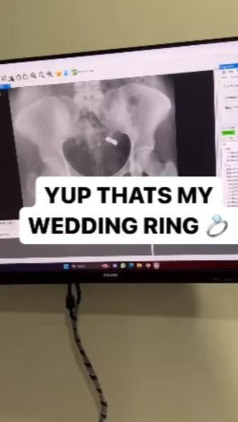 Mistaken for Medicine, Wife Unknowingly Swallows Wedding Ring While Jetlagged, Comes Out in an Unexpected Way