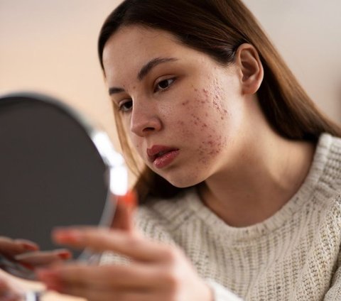 Ilustrasi Wajah Berjerawat / by freepik