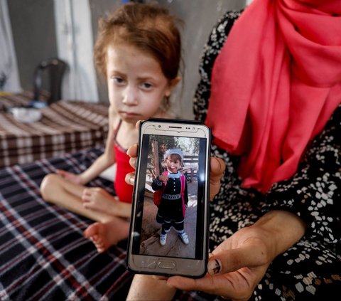 FOTO: Nestapa Gadis 5 Tahun di Jalur Gaza Menderita Kekurangan Gizi Imbas Perang, Beratnya Kini Hanya 9 Kg