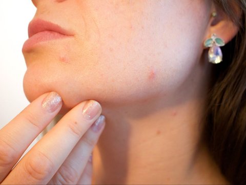 Tips Aman Menggunakan Acne Patch