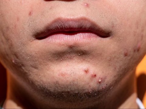 Bahaya Menggunakan Acne Patch Terlalu Lama