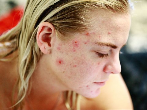 Cara Kerja Acne Patch