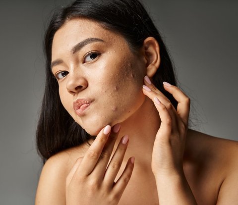 Not Effective to Use Skincare, 3 Important Procedures to Treat Acne Scars Recommended by Dermatologists