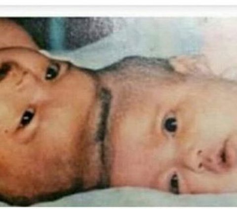 Still Remember the Siamese Twins Yuliana-Yuliani? Once Viral Became a History in the Field of Medicine, Here's the Latest News