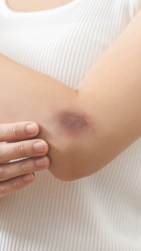 Body Often Suddenly Bruised? Could Be Due to Lack of This Vitamin