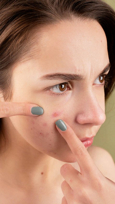 Ilustrasi memencet jerawat