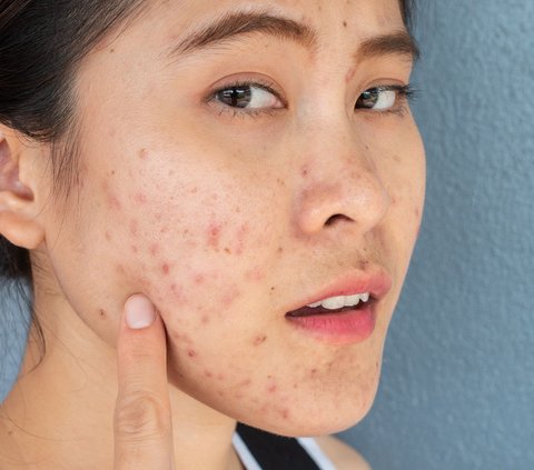 Get to Know Microbiome Technology that Prevents Acne from Recurring