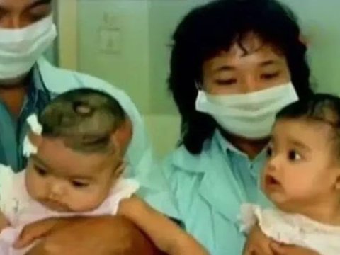 Potret Sosok Yuliana Yuliani, Bayi Kembar Siam Pertama yang Sukses Jalani Operasi Tahun 1987, Kini Jadi Dokter serta Ahli Nutrisi