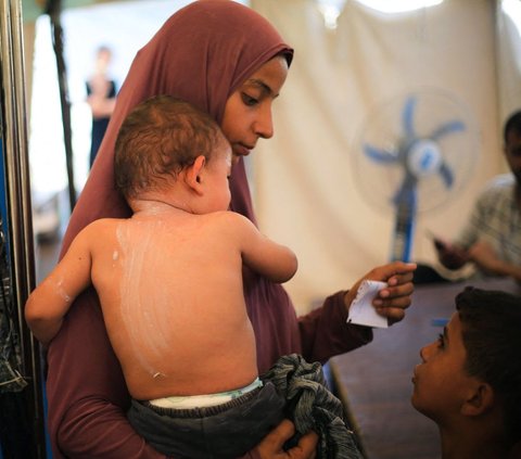 FOTO: Nestapa Anak-Anak Palestina Terpapar Penyakit Kulit Berbahaya karena Krisis Air Bersih di Jalur Gaza