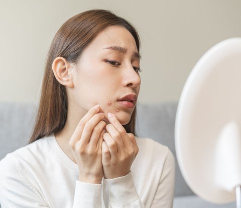 How to Use Concealer to Hide Acne, Make Your Face Look Smooth