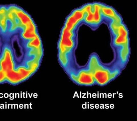 Sejarah 15 Juli 1910: Penyakit Alzheimer Dicatat Pertama Kali oleh Emil Kraepelin