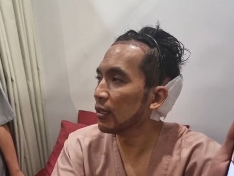 Bikin Pangling! 10 Potret Terbaru Desta Jalani Transplantasi Rambut di Klinik Tompi, Bakal Tampil Brewokan