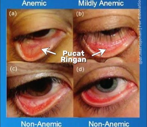 Anemia Signs Can Be Seen from the Area Under the Eyes, Try Looking at Your Eyes