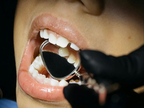 Cara Mencegah Gigi Gingsul pada Anak