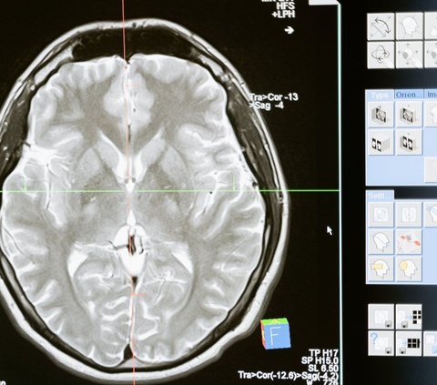 Apa Itu Aneurisme Otak? Kenali Kondisinya dari Gejala Awal yang Khas di Mata
