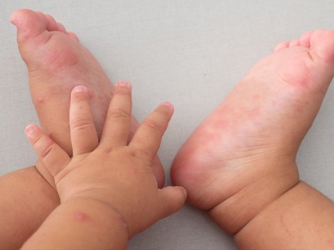 Furore Over Baby Born with 25 Fingers, Considered the Reincarnation of a Goddess