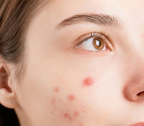 Prayer to Remove Acne and Boils, a Must-Know Acne Fighter!