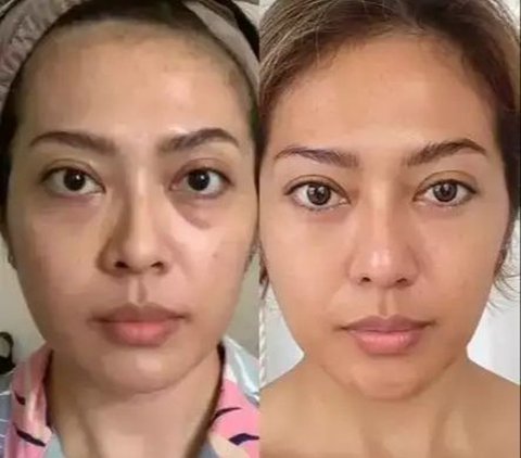 Kembali Muda Bak ABG, 9 Potret Transformasi Artis Indonesia Sebelum & Sesudah Face Lifting