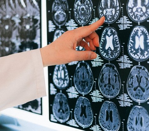 Terjadinya Hipertensi Bisa Memicu Munculnya Aneurisma Otak, Perlu Diwaspadai