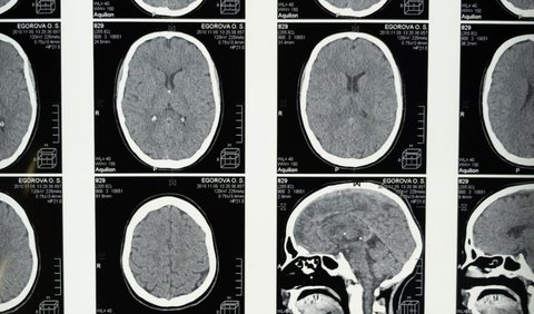Pencegahan Aneurisma Otak