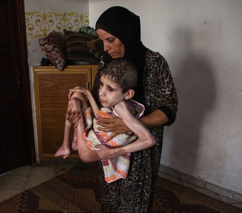 Bahaa al-Nimr, pemuda Palestina yang menderita kelumpuhan otak, digendong ibunya, Sahar, di rumahnya di lingkungan Sheikh Radwan, sebelah utara Kota Gaza, Jalur Gaza, pada 2 Juli 2024. Pengepungan Israel yang menghalangi pengiriman makanan membuat jutaan penduduk di Jalur Gaza dilanda bencana kelaparan. (Omar Al-Qattaa/AFP)