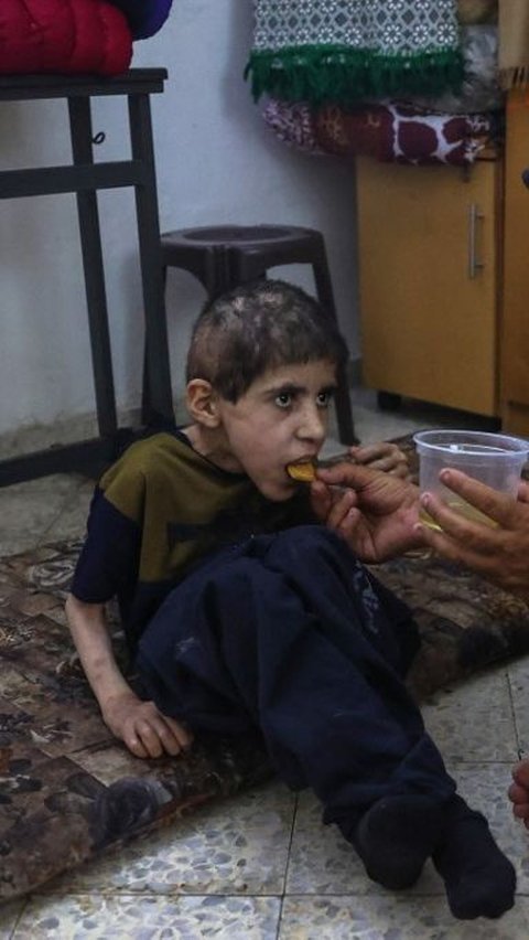 Kondisi itu menyebabkan ribuan anak-anak di Jalur Gaza menderita kekurangan gizi. Termasuk, Bahaa al-Nimr yang mengidap kelumpuhan otak atau cerebral palsy. (Omar Al-Qattaa/AFP)