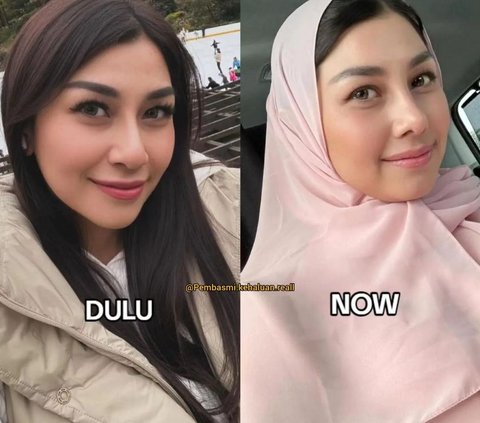 10 Artists Before VS After Plastic Surgery in 2024, Mahalini Raharja & Rizky Febian Instead Get Mocked